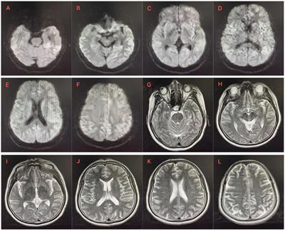 Case report: Creutzfeldt-Jakob disease: a case that initiated with the onset of obsessive-compulsive state